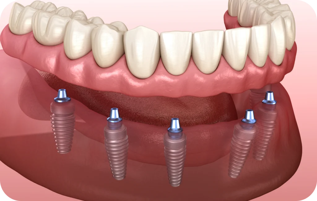 all on fixation immediate villeneuve d ascq all on fixation immediate villeneuve d ascq All on 4 / All on 6 Chirurgiens-dentistes | Villeneuve d’Ascq près de Lille
