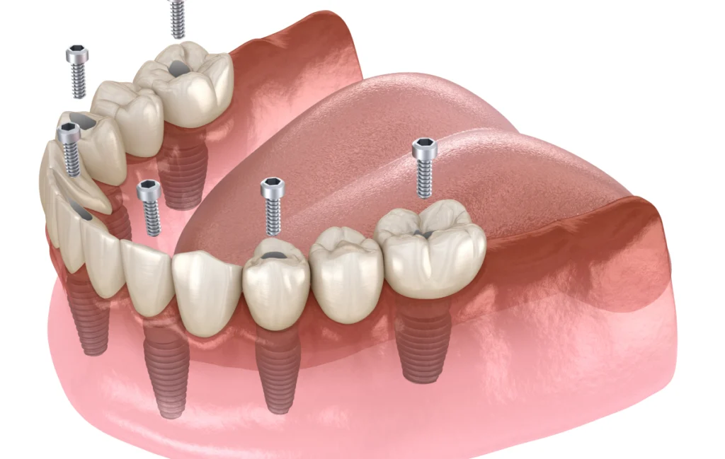 all on stabilite prothese villeneuve d ascq all on stabilite prothese villeneuve d ascq All on 4 / All on 6 Chirurgiens-dentistes | Villeneuve d’Ascq près de Lille