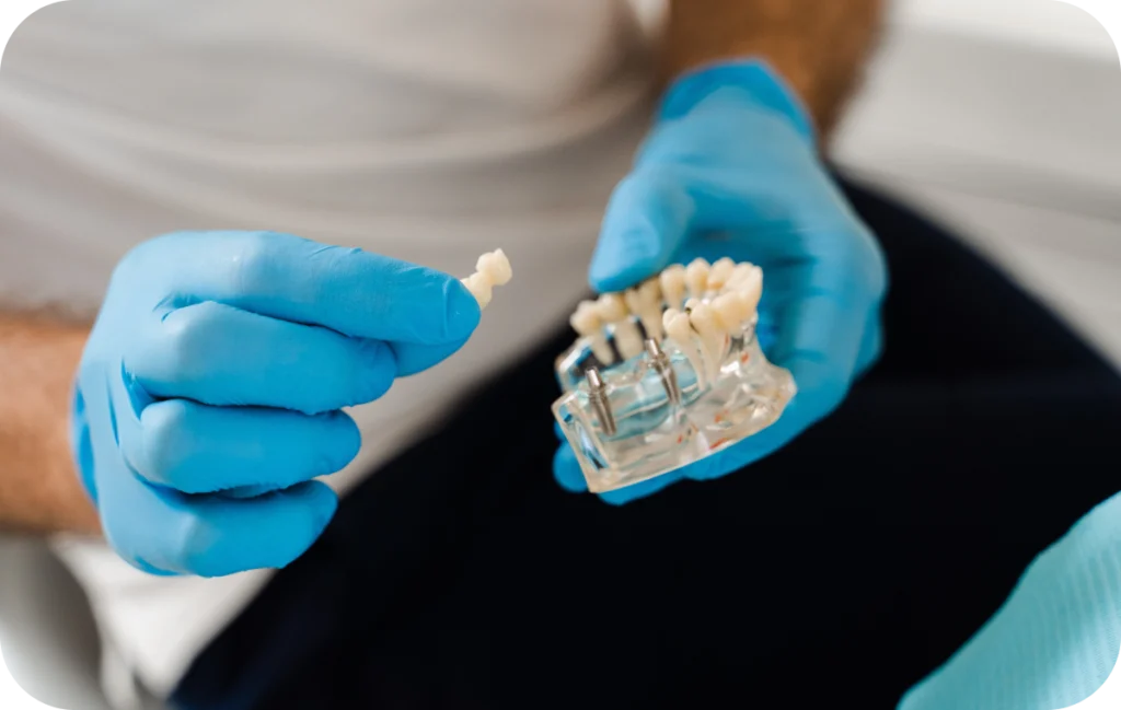 bridge implant dentaire villeneuve d ascq bridge implant dentaire villeneuve d ascq Implant dentaire Chirurgiens-dentistes | Villeneuve d’Ascq près de Lille