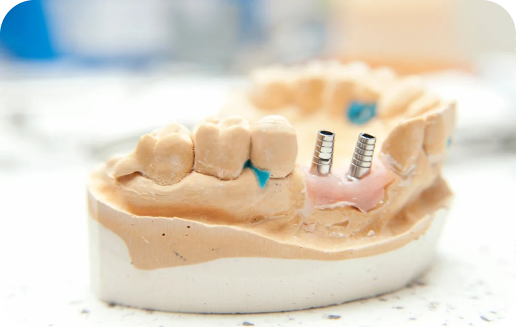 greffe osseuse cicatrisation osseuse villeneuve d ascq greffe osseuse cicatrisation osseuse villeneuve d ascq Greffe osseuse Chirurgiens-dentistes | Villeneuve d’Ascq près de Lille