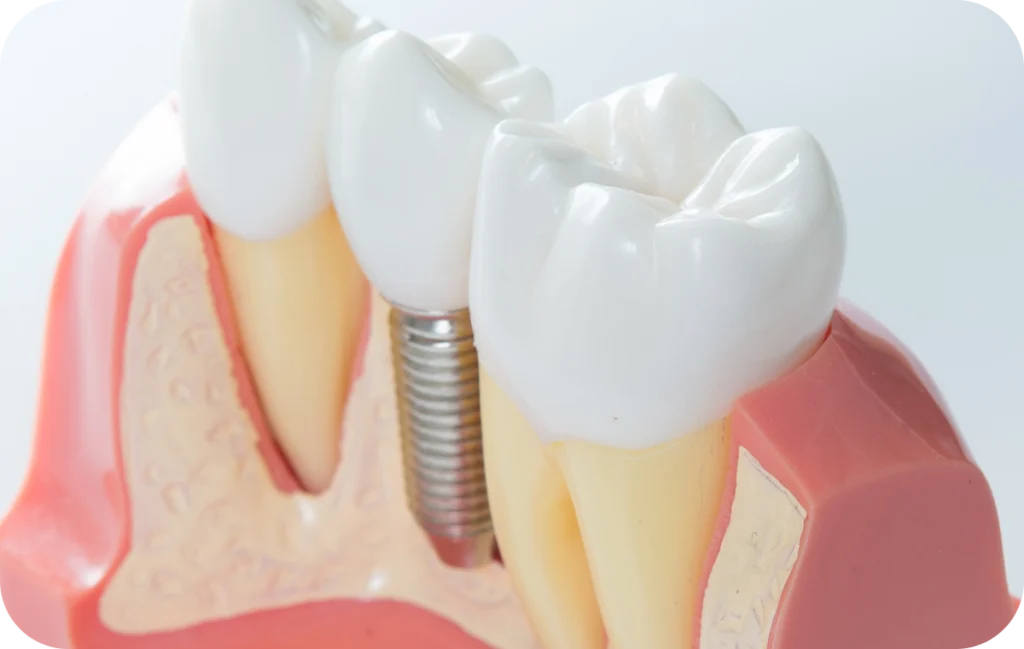 implant dentaire dentaire villeneuve d ascq Implant dentaire Chirurgiens-dentistes | Villeneuve d’Ascq près de Lille