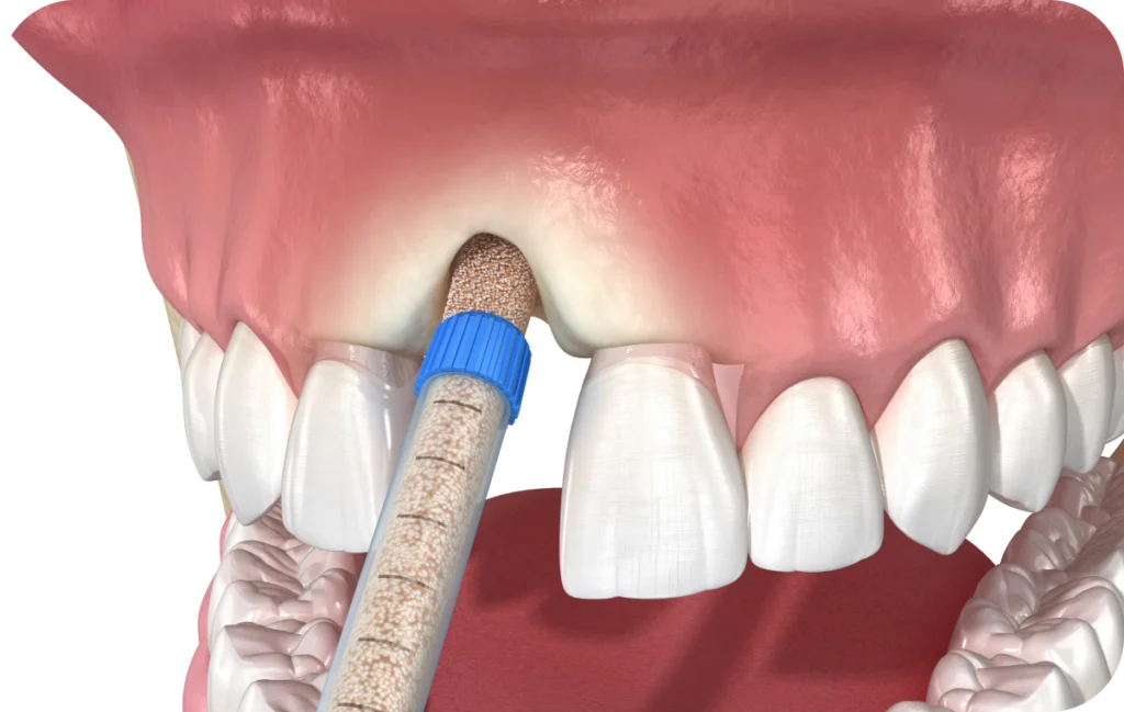 prise charge dentaire complete villeneuve d ascq prise charge dentaire complete villeneuve d ascq Préservation alvéolaire Chirurgiens-dentistes | Villeneuve d’Ascq près de Lille