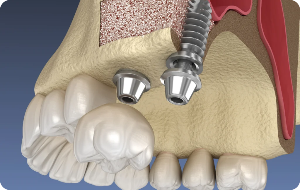 sinus lift comblement osseux villeneuve d ascq sinus lift comblement osseux villeneuve d ascq Sinus lift Chirurgiens-dentistes | Villeneuve d’Ascq près de Lille