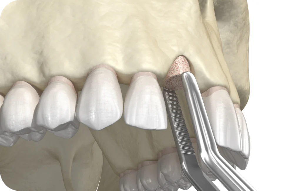 sinus lift dentaire villeneuve d ascq sinus lift dentaire villeneuve d ascq Greffe osseuse Chirurgiens-dentistes | Villeneuve d’Ascq près de Lille