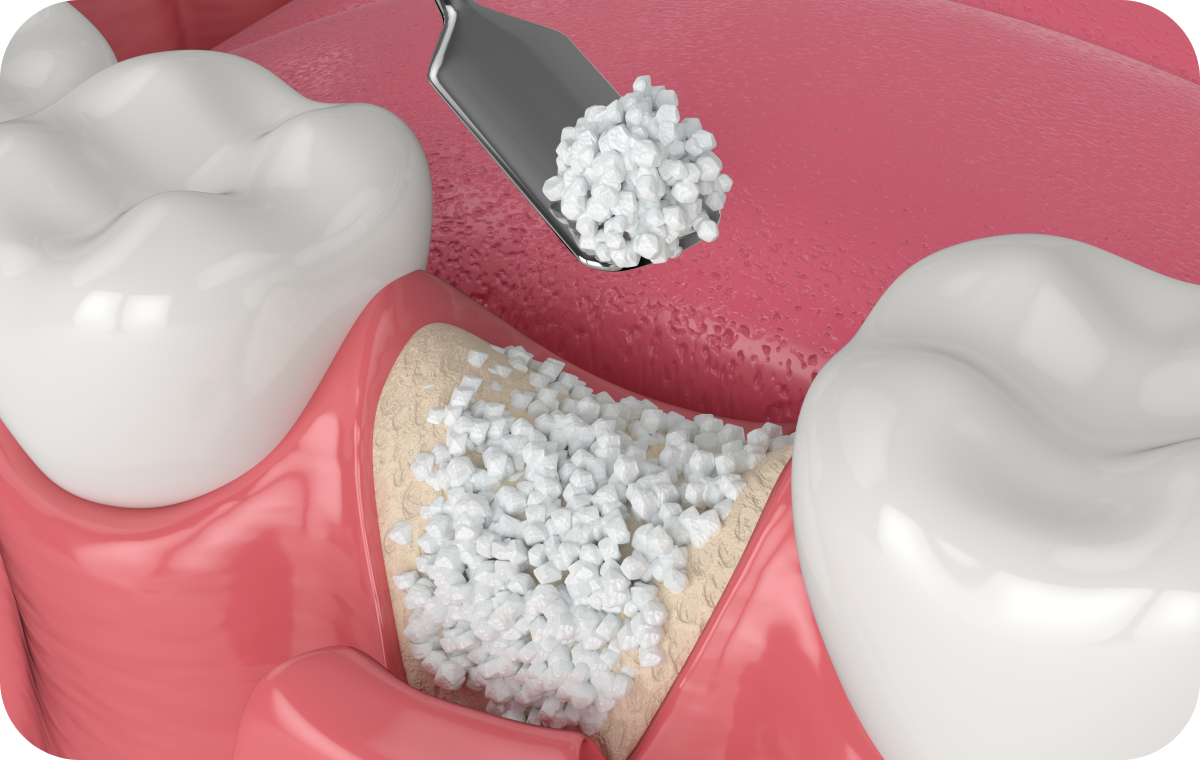 Préservation alvéolaire