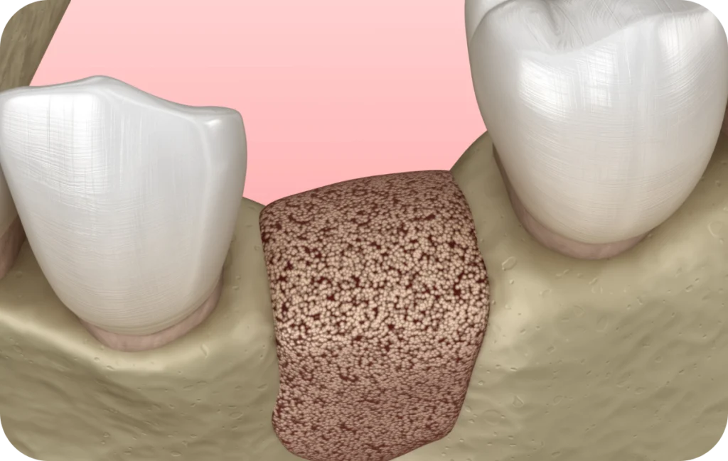 soins gencives prevention parodontale villeneuve d ascq soins gencives prevention parodontale villeneuve d ascq Préservation alvéolaire Chirurgiens-dentistes | Villeneuve d’Ascq près de Lille