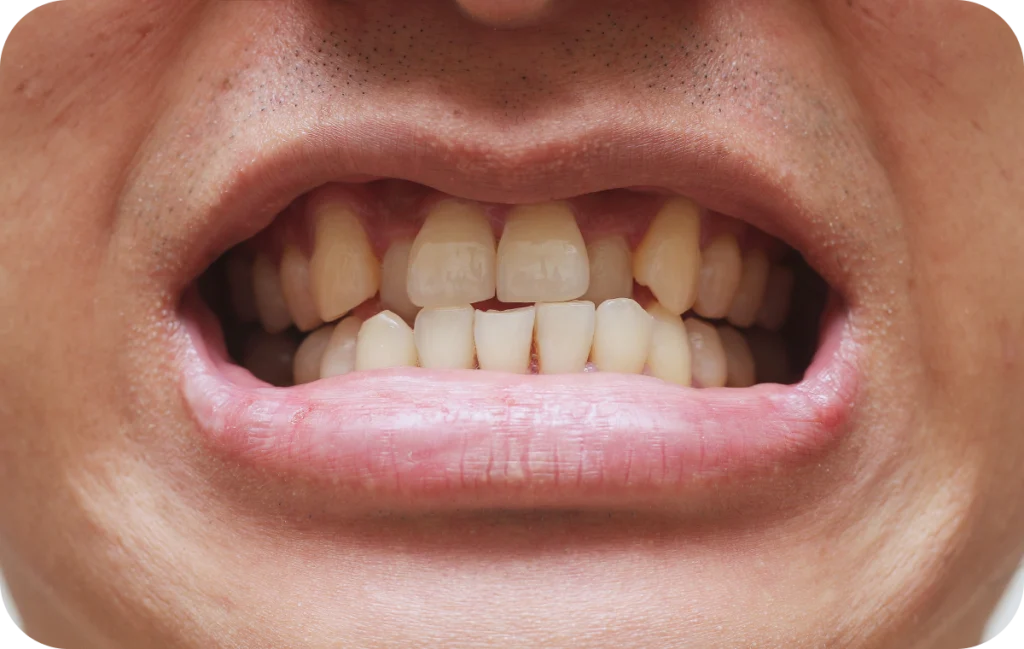 appareils dentaires repositionnement dents villeneuve d ascq appareils dentaires repositionnement dents villeneuve d ascq Orthodontie Chirurgiens-dentistes | Villeneuve d’Ascq près de Lille