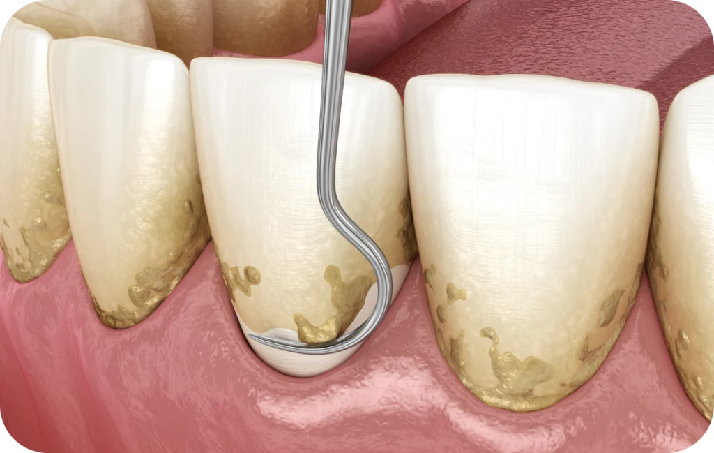 soins gencives suivi parodontal villeneuve d ascq soins gencives suivi parodontal villeneuve d ascq Soins des gencives Chirurgiens-dentistes | Villeneuve d’Ascq près de Lille